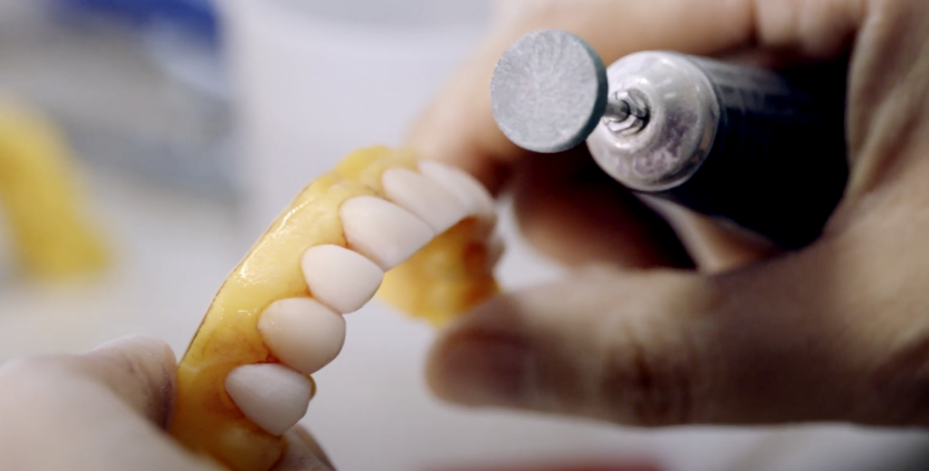 Dental technician using precision tools to craft and refine MINISH veneers.