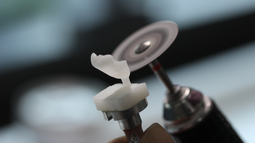 Close-up of teeth preparation and digital veneer customization process at MINISH Dental Hospital.