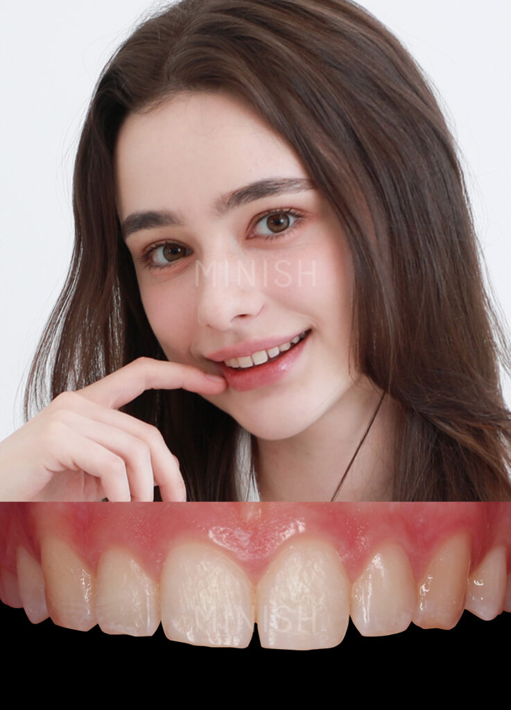 A portrait of a female patient alongside a detailed close-up of natural teeth with minor gaps and discoloration before MINISH treatment.