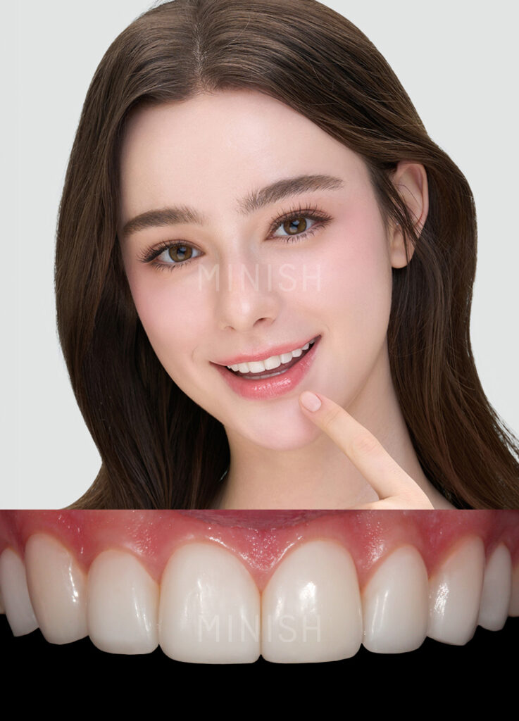 A confident patient smiling next to a high-definition close-up of symmetrical, bright white MINISH veneers after successful treatment.