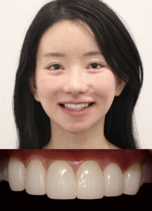 A confident smile featuring symmetrical, bright, and ultra-thin MINISH veneers after treatment.