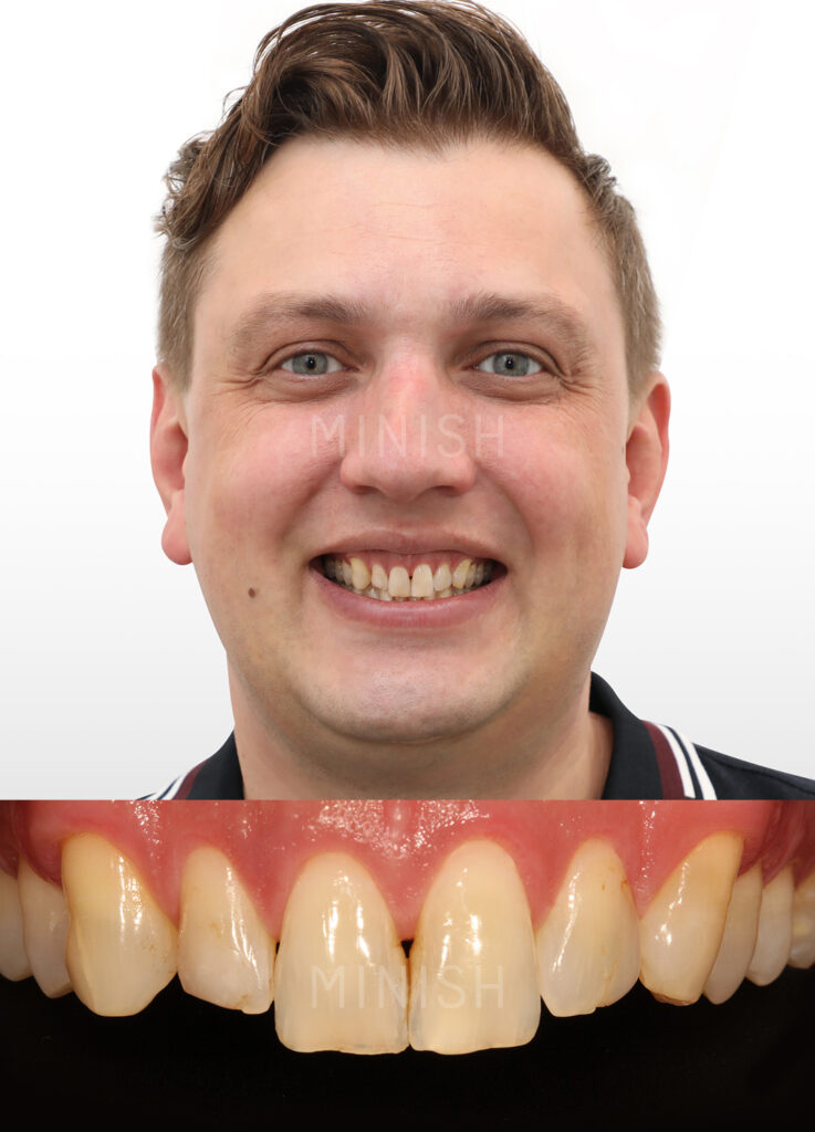 Close-up of a patient's natural teeth showing minor gaps and discoloration before receiving ultra-thin MINISH veneers.