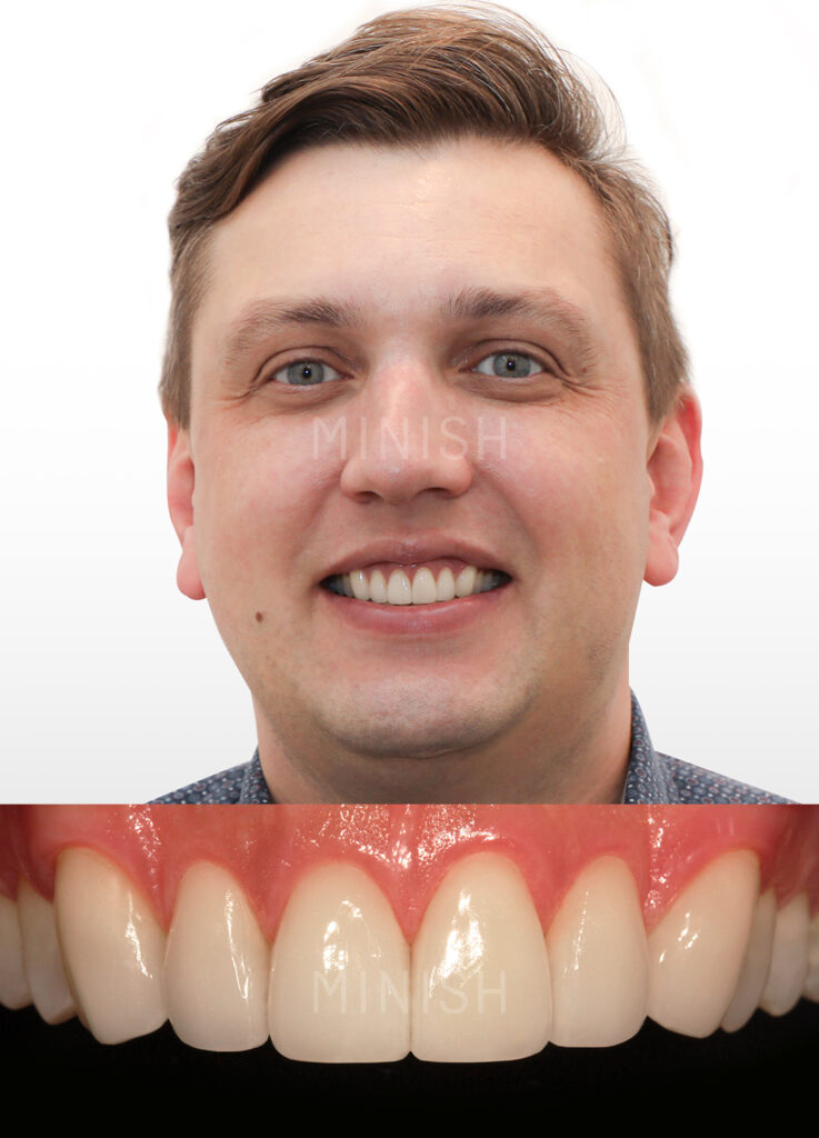 The patient’s final smile after MINISH treatment, featuring ultra-precision 0.1mm ceramic veneers that blend seamlessly with natural teeth.