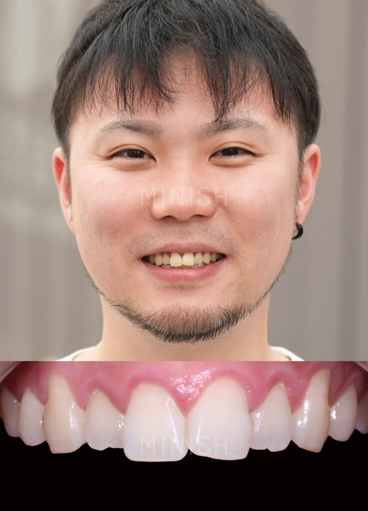 A portrait of a man with a close-up of his natural teeth showing minor misalignment before MINISH dental treatment.