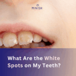 What Are the White Spots on My Teeth?