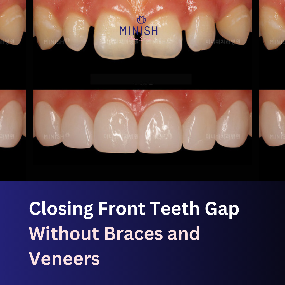 Closing Front Teeth Gap Without Braces and Veneers