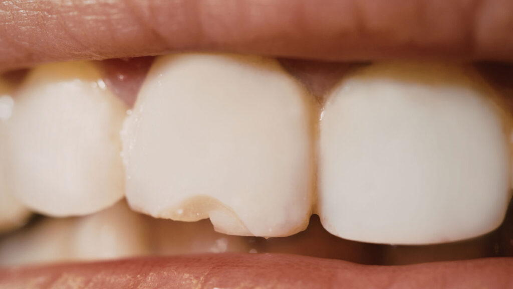 Close-up of a chipped upper front tooth before restorative dental treatment.