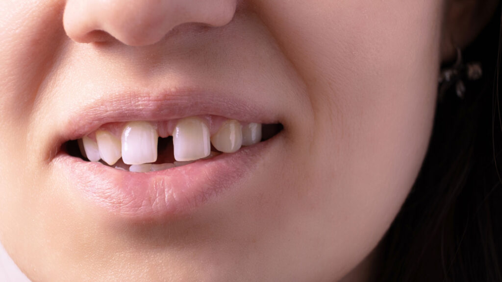 Close-up of uneven or gapped front teeth before correction with minimally invasive MINISH technology.