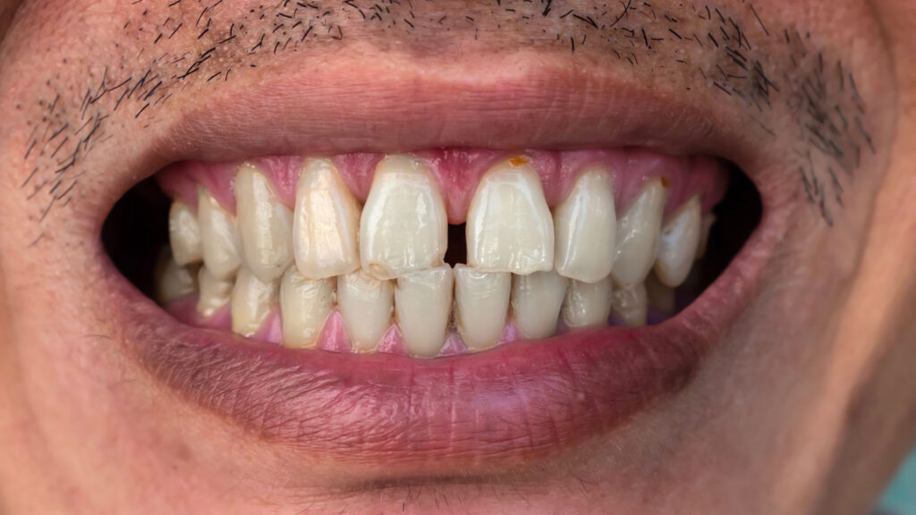 Close-up of a patient's smile featuring a prominent gap between the upper front central incisors (diastema) before MINISH treatment.