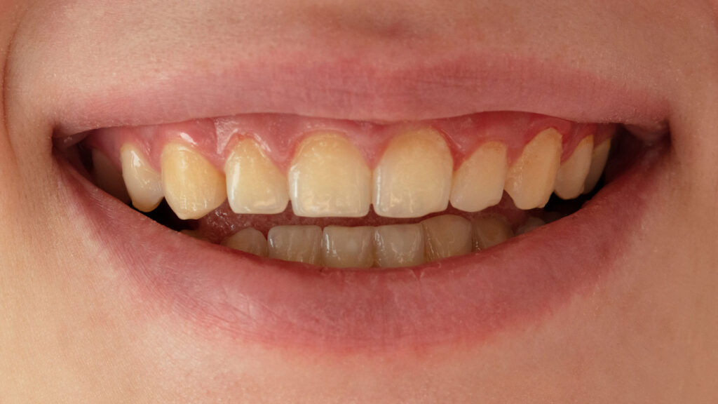 Yellowing teeth to demonstrate the whitening potential of MINISH veneers.