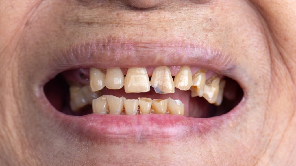 Close-up of a patient with severely worn, chipped, and yellowed teeth before receiving MINISH restorative veneers.