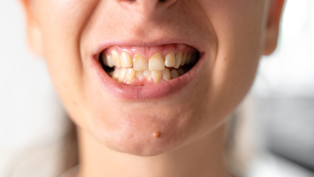 Extreme close-up of unproportionate teeth and uneven gum lines before corrective MINISH restoration.