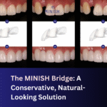 The MINISH Bridge: A Conservative, Natural-Looking Solution