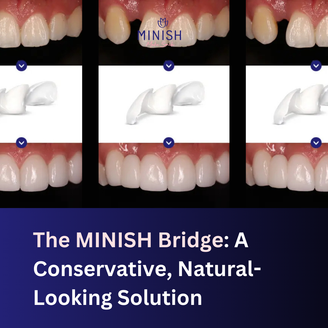 The MINISH Bridge: A Conservative, Natural-Looking Solution